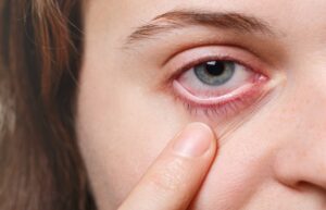 Dry eye syndrome, a pathology on the rise