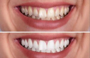 Teeth whitening: how does it work?