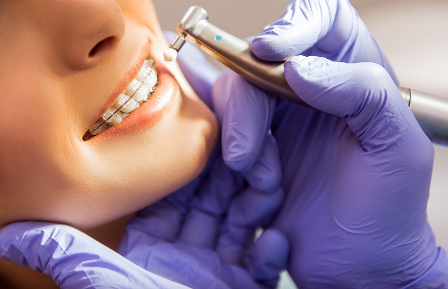 Orthodontic Treatment 101: What You Need to Know Before Getting Braces
