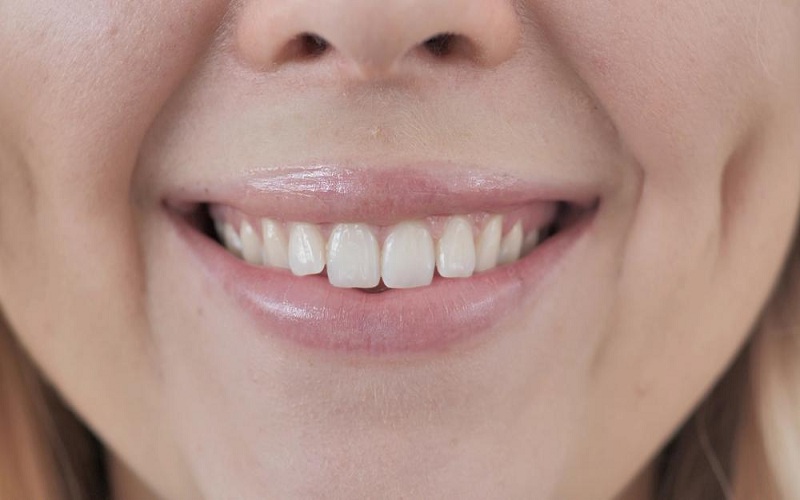 Tooth Contouring: Subtle Changes, Big Impact