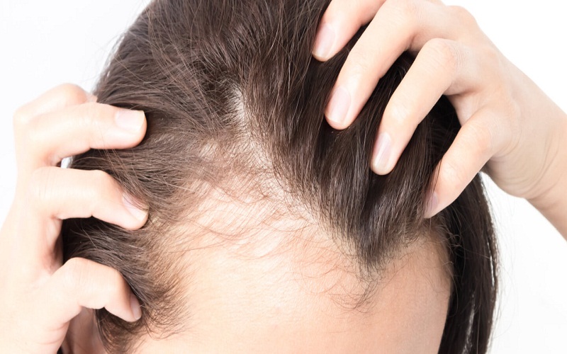 Dermatologists And Hair Loss