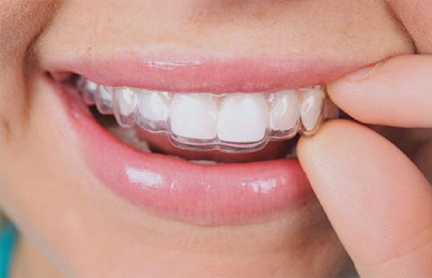 The Evolution Of Teeth Whitening In Cosmetic Dentistry