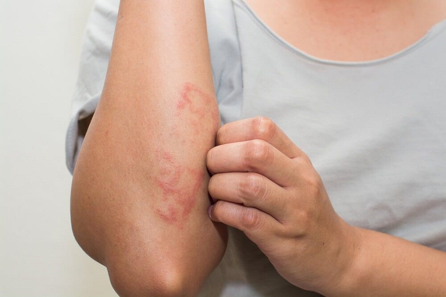 Allergic Reactions And Skin: The Dermatologist’s Role