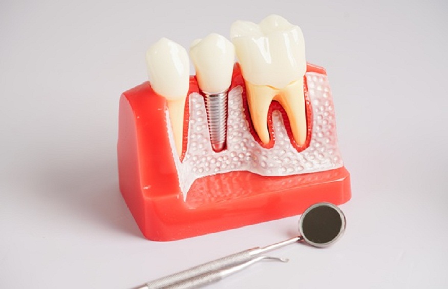 Dental Implants