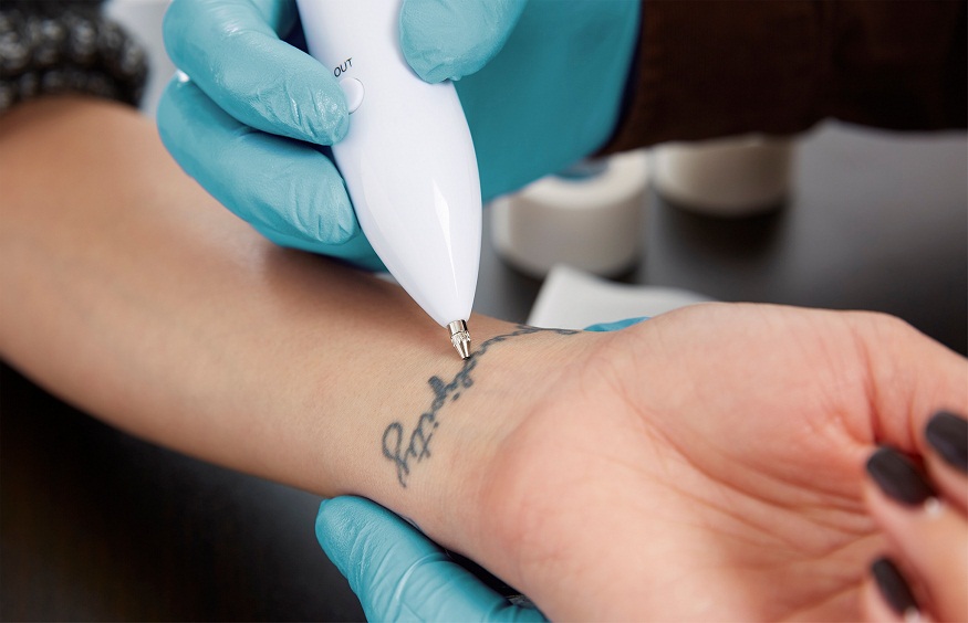 spring tattoo removal,