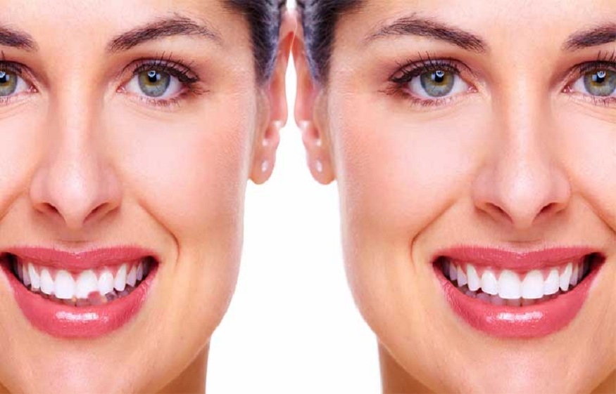 Teeth Reshaping And Contouring