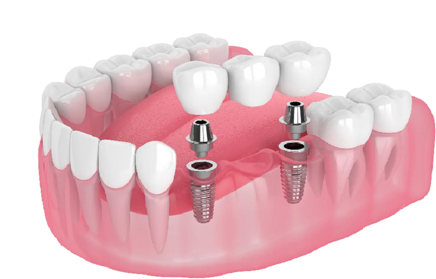 Tukwila dental implants,