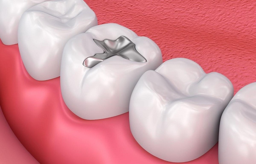 When to Replace a Dental Filling: Key Signs You Can’t Ignore