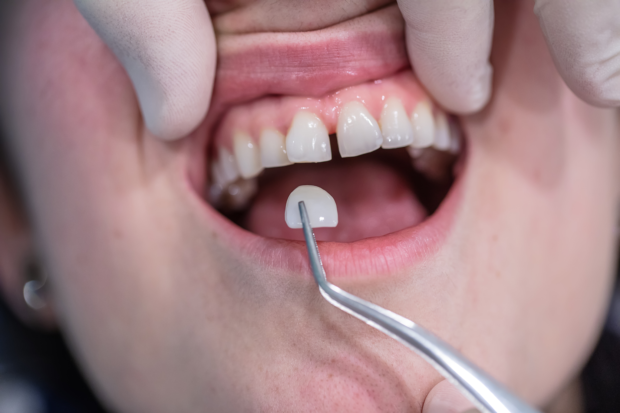 The Difference Between Cleaning Your Teeth and Strengthening Them